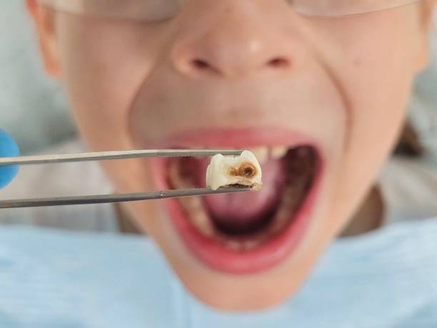 Best Emergency Treatment for Toothache in Ramsey, MN