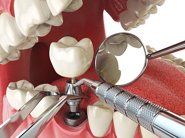 Best Emergency Root Canal Treatment in Ramsey, MN
